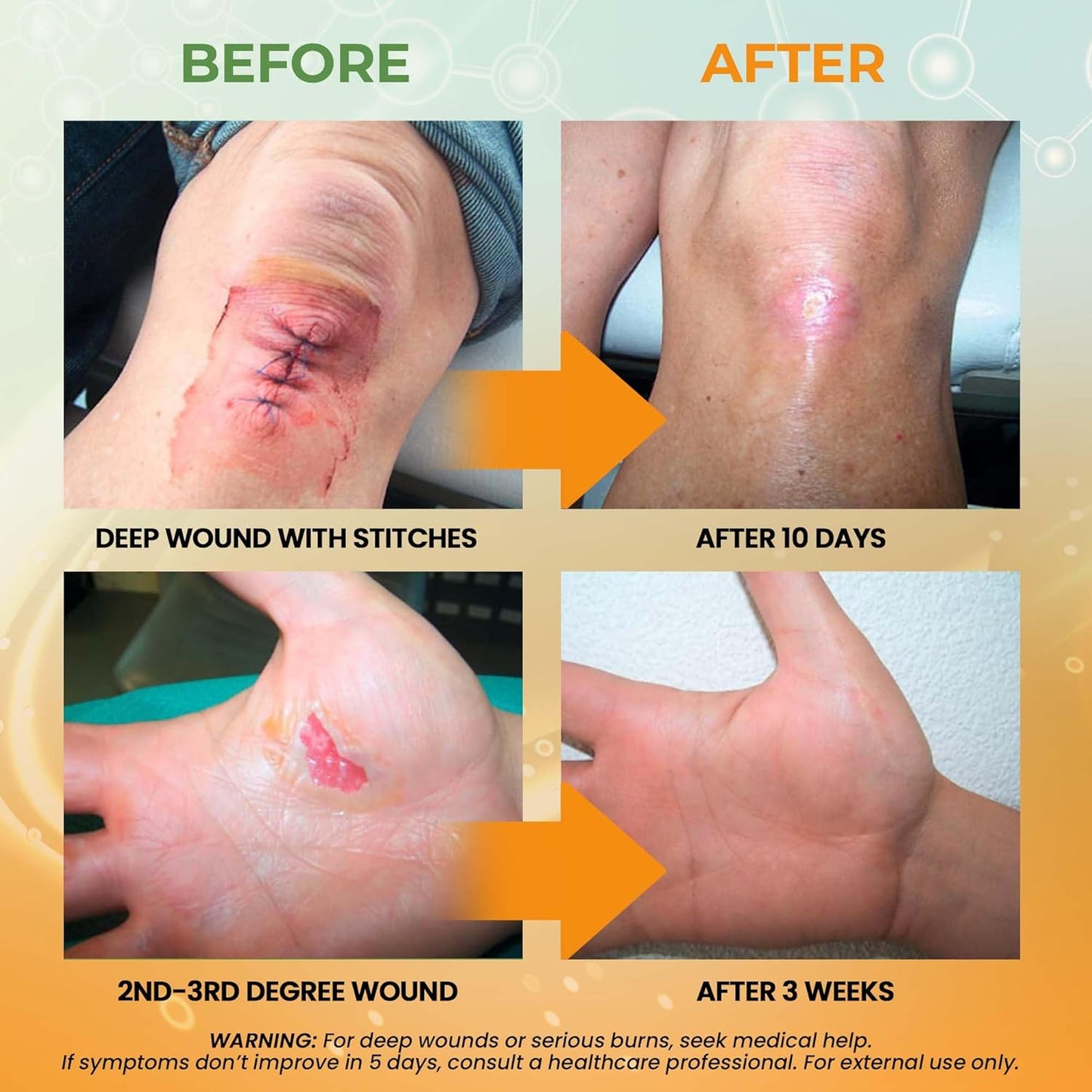 MediQuick Skin & Wound Repair First Aid Spray Gel 4 Fl Oz - Antiseptic Spray for Burns & Cuts with 12 Hour Action - Helps Heal Acne Rash Eczema Itch Bites & More - Safe Wound Wash with No Sting