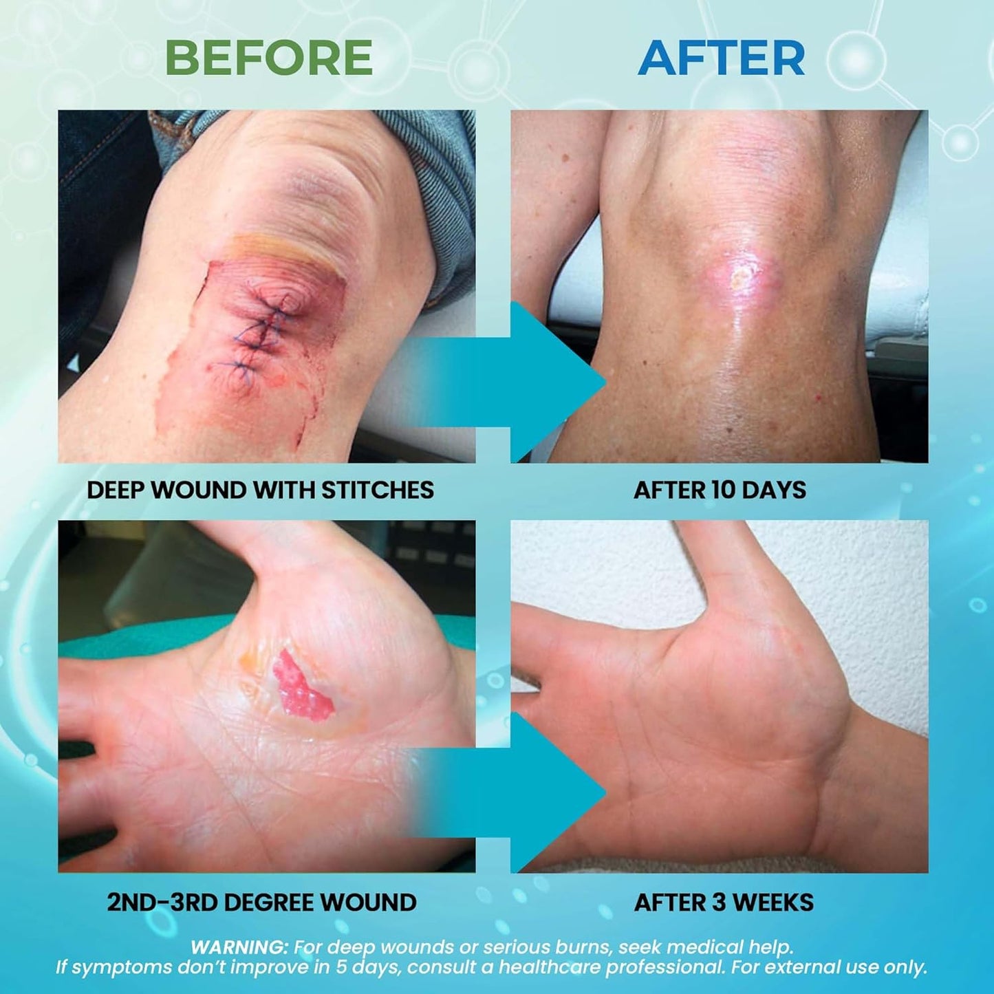 MediQuick Antiseptic Spray Mist 4 Fl Oz | Skin & Wound Repair First Aid Spray for Burns & Cuts with 12 Hour Action | Helps Heal Acne Rash Eczema Itch Bites & More | Safe Wound Wash with No Sting